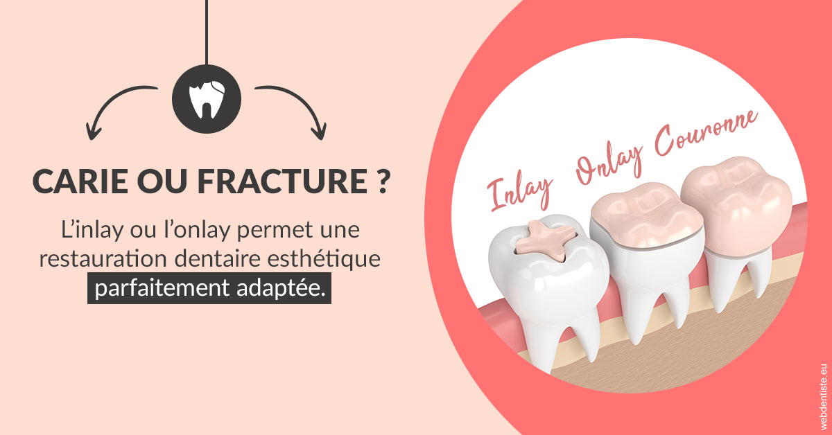 https://www.orthodontie-allouch-et-associes.fr/T2 2023 - Carie ou fracture 2
