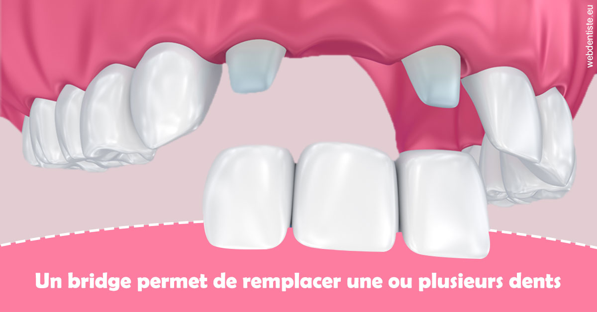 https://www.orthodontie-allouch-et-associes.fr/Bridge remplacer dents 2