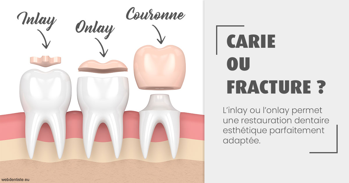 https://www.orthodontie-allouch-et-associes.fr/T2 2023 - Carie ou fracture 1