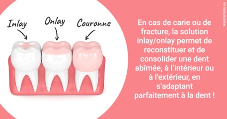 https://www.orthodontie-allouch-et-associes.fr/L'INLAY ou l'ONLAY 2