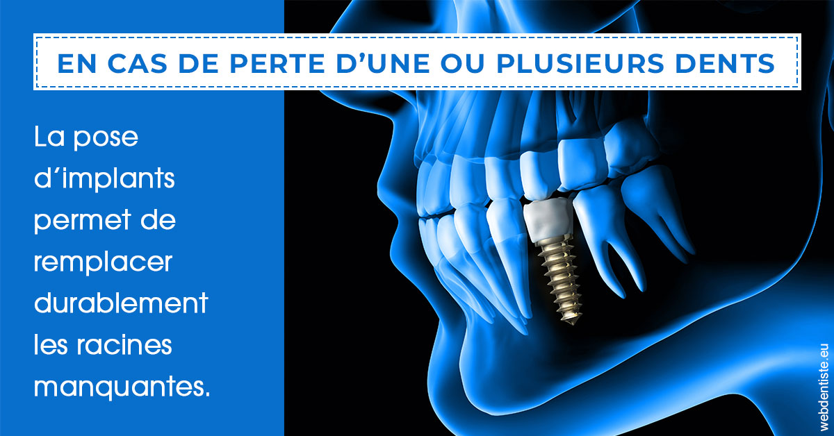 https://www.orthodontie-allouch-et-associes.fr/2024 T1 - Implants 01