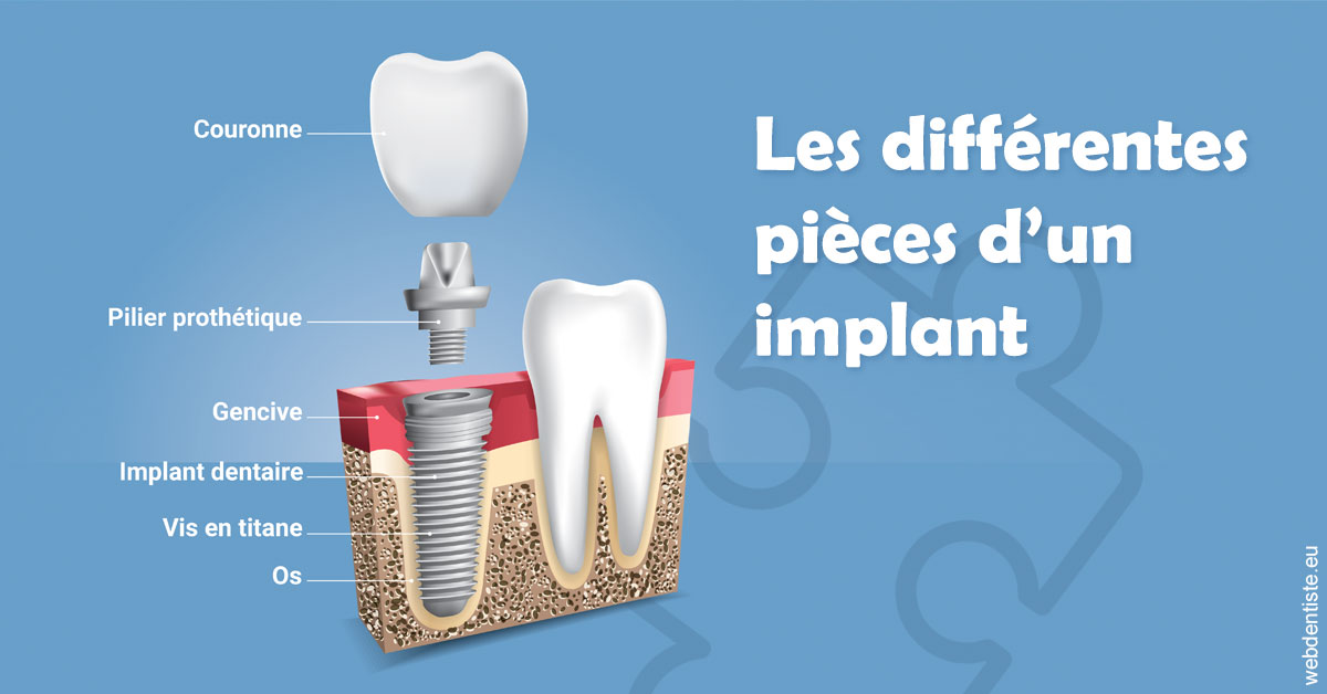 https://www.orthodontie-allouch-et-associes.fr/Les différentes pièces d’un implant 1