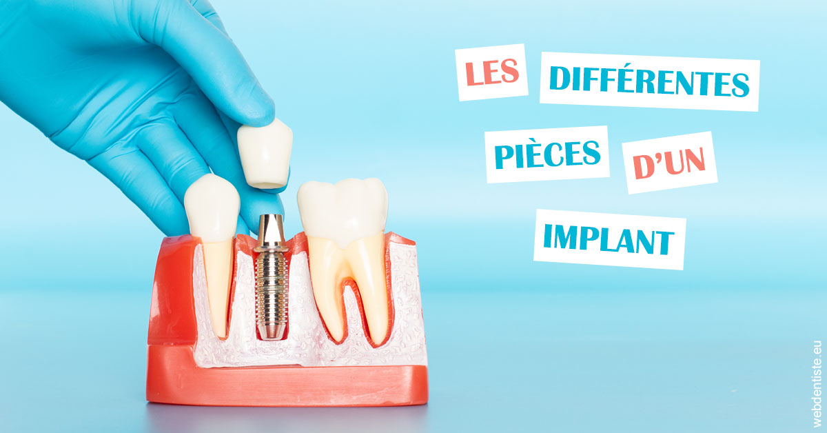 https://www.orthodontie-allouch-et-associes.fr/Les différentes pièces d’un implant 2